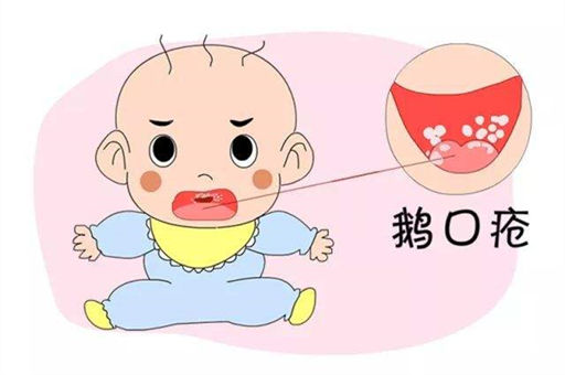 新生儿为何反复出现鹅口疮？如何避免预防？