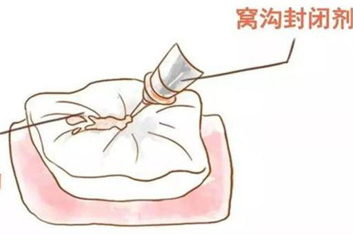 窝沟封闭能防止蛀牙吗