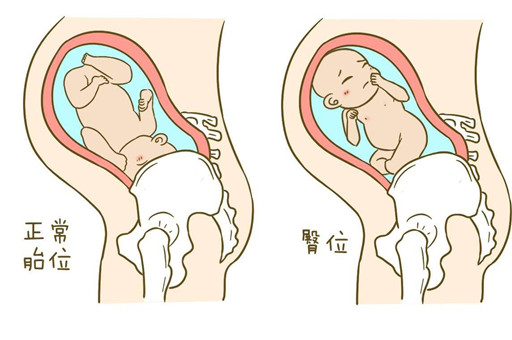 什么是胎儿臀位？胎儿臀位怎么办？